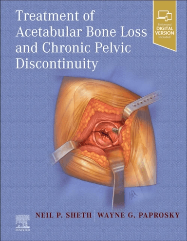 Treatment of Acetabular Bone Loss and Chronic Pelvic Discontinuity av Neil P. Sheth, Wayne MD FACS (Professor Department of Orthopaedics Section of Ad